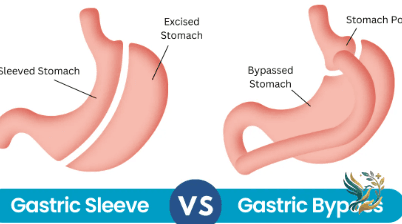 Gastric Sleeve Surgery in Egypt: Cost, Surgeons & Complete Guide (2026)
