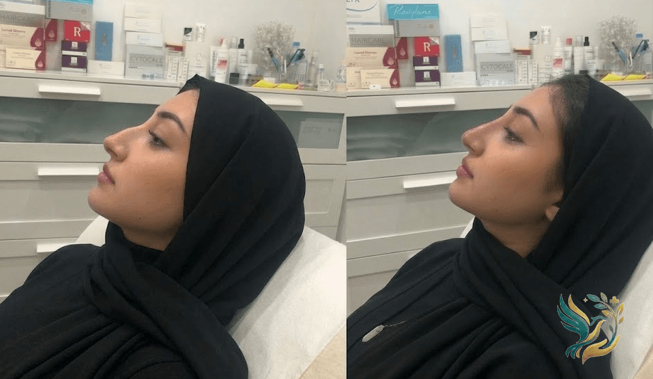 Sarah's Story: From London to Cairo for Rhinoplasty - And Saving Over 4,000 Pounds