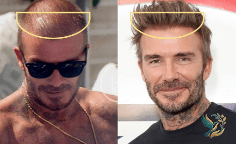 Hair Transplant in Cairo: Cost, Clinics & What to Expect (2026)